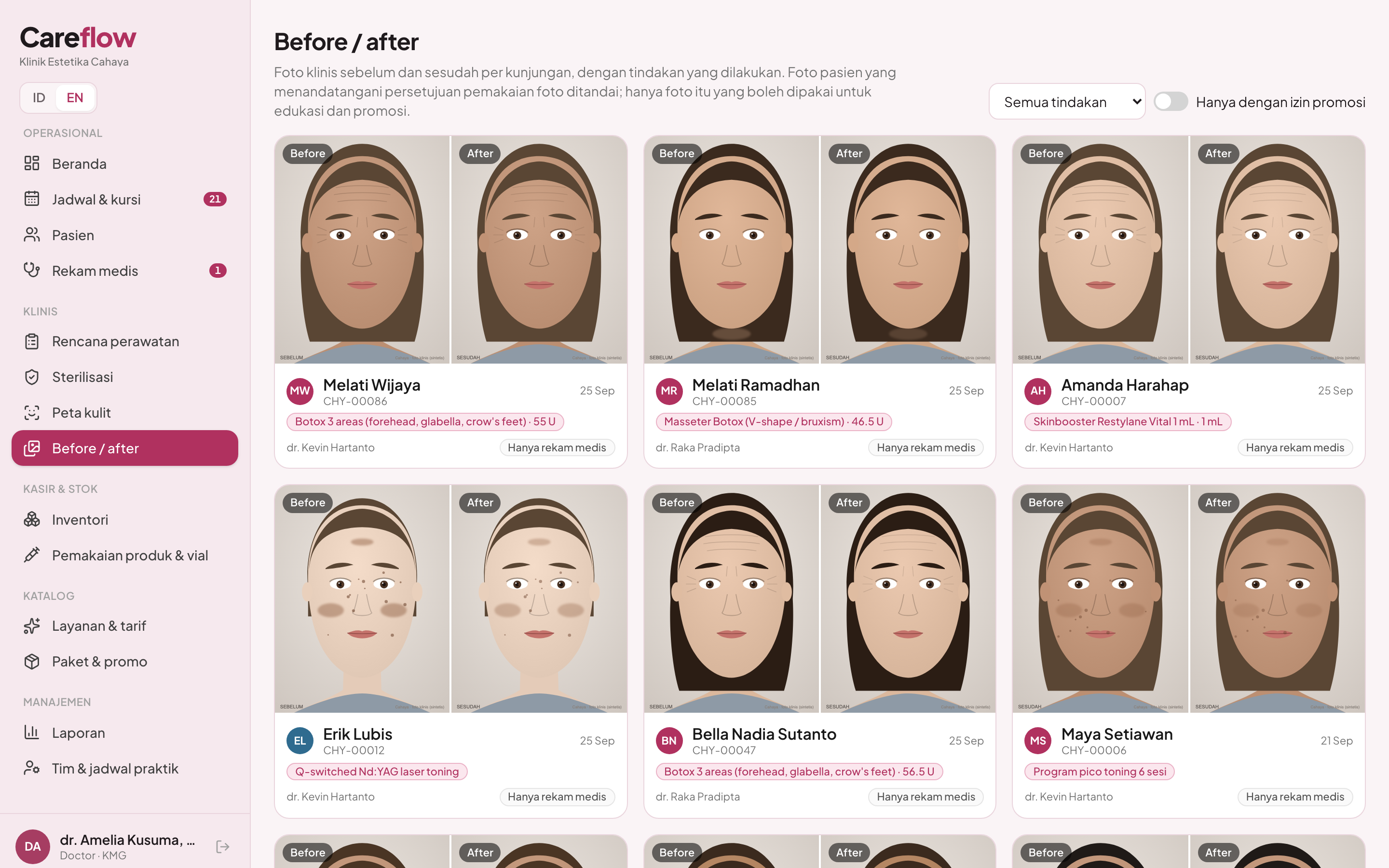 Before-after