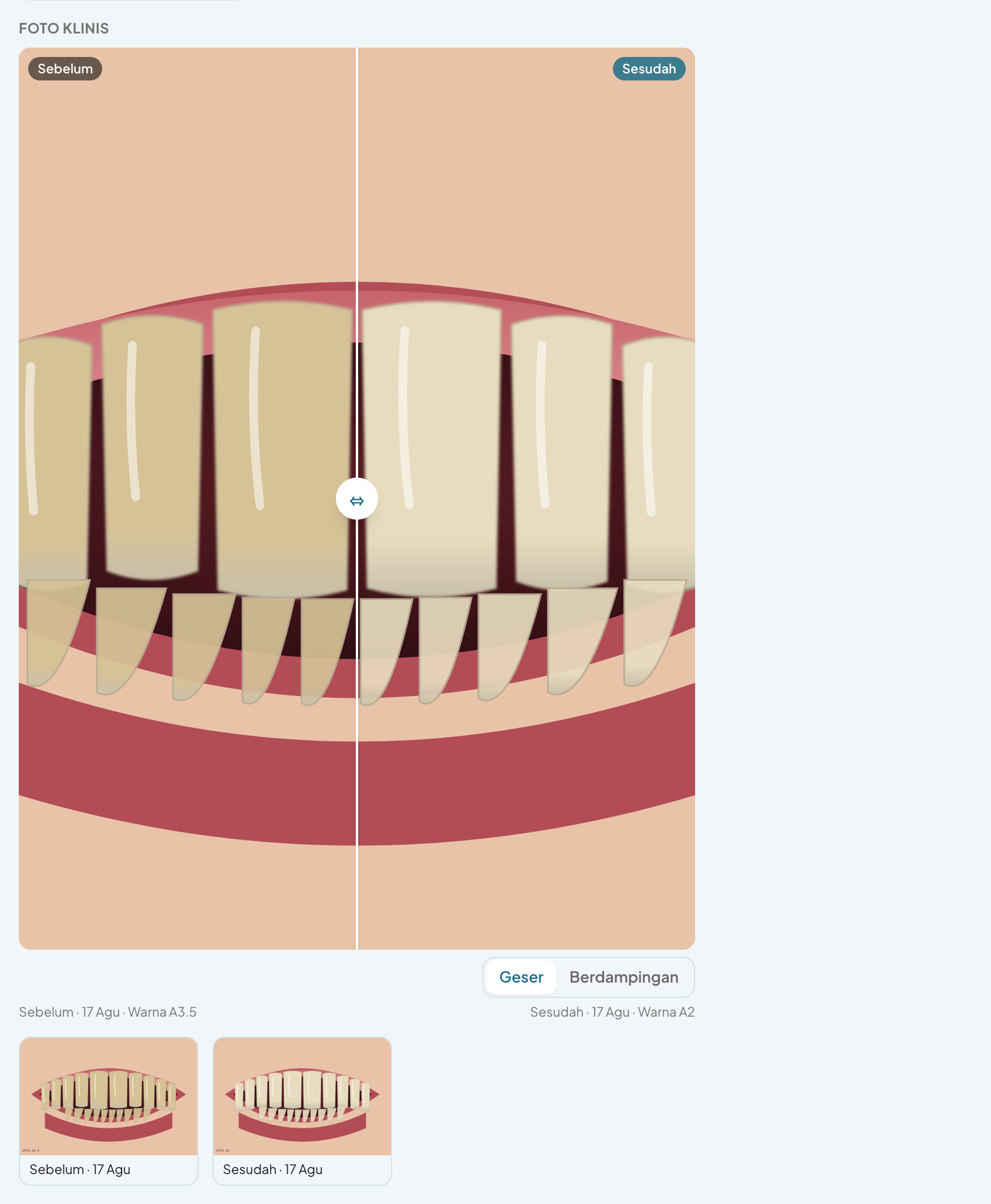 Foto intraoral sebelum dan sesudah